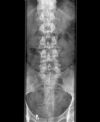 L3/4 lumbar Disciitis. AP radiograph. Courtesy of www.healthengine.com.au