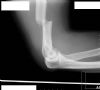 Right distal third humerus / Holstein-Lewis fracture. Lateral radiograph. This patient presented with a complete radial nerve palsy