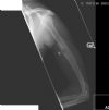 Left open mid-shaft humerus fracture. Bullet in situ. united after 5 months non-operative treatment. AP radiograph