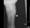 Oblique subtrochanteric Femur fracture - Lateral view