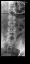 L1 Lumbar vertebral fracture. AP radiograph. Courtesy of www.healthengine.com.au