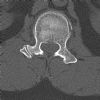 L1 Lumbar vertebral fracture. Axial CT (3). Courtesy of www.healthengine.com.au