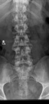 L3/4 lumbar Disciitis. AP radiograph. Courtesy of www.healthengine.com.au