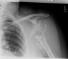 Fracture Dislocation (Anterior) of Left Shoulder - AP View (1)