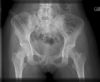 Pelvic fracture. Radiograph. Courtesy of www.healthengine.com.au