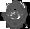 Fracture through the left anterior and posterior arches of the atlas with some lateral displacement of the left lateral mass. Axial CT 2.