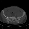 Lateral compression pelvic fracture. CT. Courtesy of Dushan Atkinson