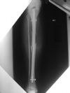 Segmental tibia with IL nail