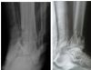 Comminuted Pilon fracture (closed)