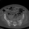 Pelvic bony metastasis. Courtesy of www.healthengine.com.au