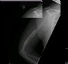 ORIF of distal humeral fracture through posterior approach