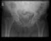 Pelvic fracture. Radiograph. Courtesy of www.healthengine.com.au