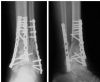 ORIF of Pilon fracture