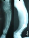 post traumatic pseudoarthrosis tibia