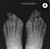 Rheumatoid feet