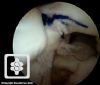 SLAP repair arthroscopy