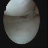 Complex posterior horn medial meniscal tear