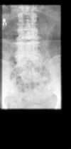 L3/4 lumbar Disciitis. AP radiograph. Courtesy of www.healthengine.com.au