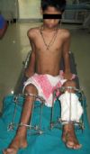 Ellis-van Creveld Syndrome (1)