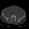 Lateral compression pelvic fracture. CT. Courtesy of Dushan Atkinson