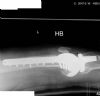 lateral of Knee after fixation of peri-prosthetic fracture with 13 hole PERILOC plate and locking screws

History : 70 yr female, underwent PFC total knee replacement, then subsequent non-traumatic fracture 11 days post op
