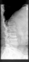 L3/4 lumbar Disciitis. Lateral radiograph. Courtesy of www.healthengine.com.au