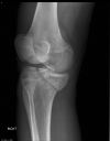 Tibial plateau fracture. Variant of Schatzker 5. Courtesy of www.healthengine.com.au