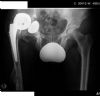 AP pelvis 2 weeks postop in 36 yr male with acetabular collapse and Protrusio after complex primary total hip replacement with biomet taperloc stem, 36mm ceramic on ceramic head/liner. There is dislocation of the prosthesis and the liner has fallen out of the cup. 

History:RTA 10 yr ago, motorcycle vs bus, fracture right femur and tibia treated with IM nails, and fractured acetabulum managed conservatively. Presents with pain and 4cm shortening of right femur, he has a dilated acetabulum with evidence of old central dislocation. Imaging of the pelvis demonstrates protrusion of the right femoral head through the acetabulum into the pelvis. There is deformity of the femoral head with some reactive sclerosis seen in the adjacent acetabular margins. The medial wall of the right acetabulum is deficient and there is superior and central dislocation of the femoral head with secondary osteoarthritis.
