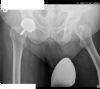 AP radiograph - biomet re-surfacing