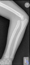 Plastic deforation of ulna with anterior dislocation radial head (Monteggia variant) 