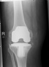 Loose total knee replacement - AP view (1)