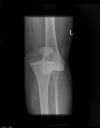 Left knee postero-medial dislocation. Ouch! AP radiograph. Courtesy of Dushan Atkinson