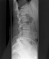 L3/4 lumbar Disciitis. AP radiograph. Courtesy of www.healthengine.com.au