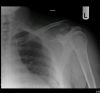 Neer Type II B distal clavicle fracture