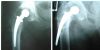 Failure of Total Hip Arthroplasty