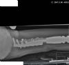 lateral of proximal femur showing reconstruction of peri-prosthetic fracture of non-invasive growing femoral replacement with plate, cables and fibula strut graft.

History: 9 yr male with osteosarcoma of distal femur.