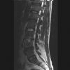 L3/4 lumbar Disciitis. Sagittal T2 MRI (4). Courtesy of www.healthengine.com.au