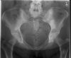 Pelvic bony metastasis. Courtesy of www.healthengine.com.au