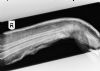 Dorsally angulated fracture of  the right distal radius - in POP - Lateral view (4)