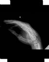 4th adn 5th metacarpal fractures. Radiograph. Courtesy of www.healthengine.com.au