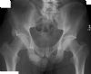 Pelvic osteochondroma. Courtesy of www.healthengine.com.au