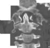 Fracture through the left anterior and posterior arches of the atlas with some lateral displacement of the left lateral mass. Coronal CT.