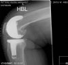 Lateral of Knee: Notching of femur post knee replacement is clearly seen
History : 70 yr female, underwent PFC total knee replacement, then subsequent non-traumatic fracture 11 days post op
