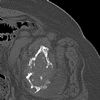 Pelvic bony metastasis. Courtesy of www.healthengine.com.au