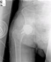 Hip resurfacing - Post-Op X Ray and evaluation
