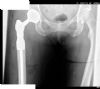 AP radiograph of pelvis - right sided proximal femoral replacement