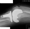 Lateral of Knee peri-prosthetic fracture: Notching of femur post knee replacement is clearly seen with oblique fracture

History : 70 yr female, underwent PFC total knee replacement, then subsequent non-traumatic fracture 11 days post op

