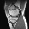 MRI Knee - T1W - Sagittal - Simple Tibial Osteochondroma 00