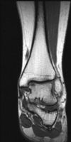 MRI Ankle - T1W - Coronal -Osteochondral defect - superior medial aspect of the talar dome
