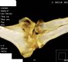 Distal humerus intra-articular fracture with large capitellar fragment and radial head fracture. CT 3D reconstruction 3